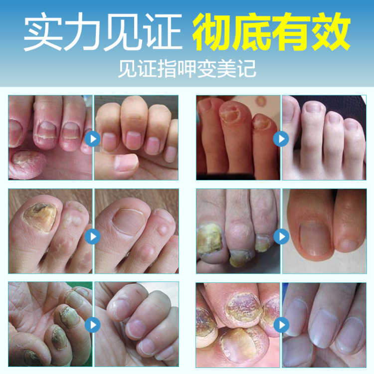 【2送1】灰指甲亮甲灰指甲增厚亮灰甲灰指甲抑菌液灰指甲液