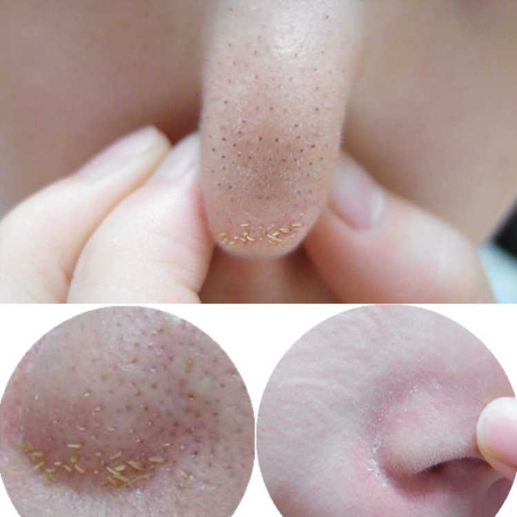 用什么可以去黑头和收缩毛孔 4d387ef49e828efb17b998801c0ff2b9.jpeg